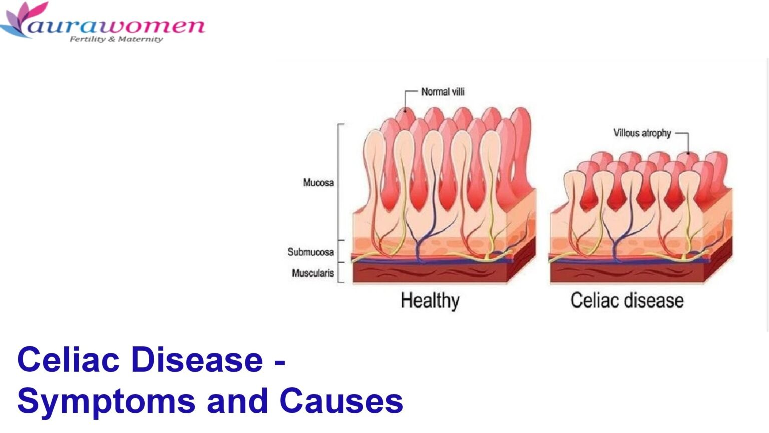 Celiac Disease – Symptoms and Causes | Aurawomen