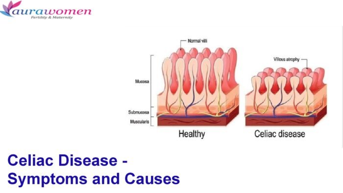Celiac Disease – Symptoms and Causes | Aurawomen